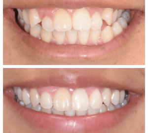 Ortho Richmond clear aligners