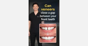Can veneers close a gap between your front teeth?