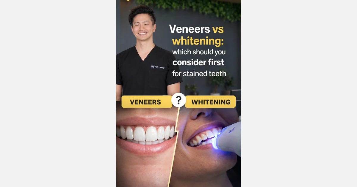 Should You Whiten Before Veneers for Stained Teeth?